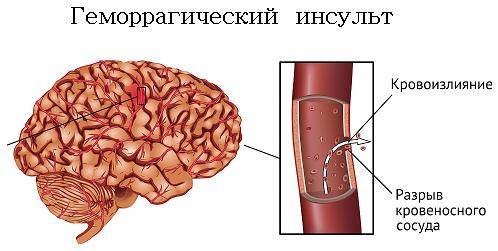 Геморрагический инсульт причины