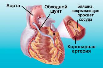 ИБС у женщин