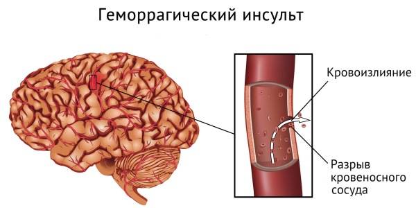 Геморрагический пример