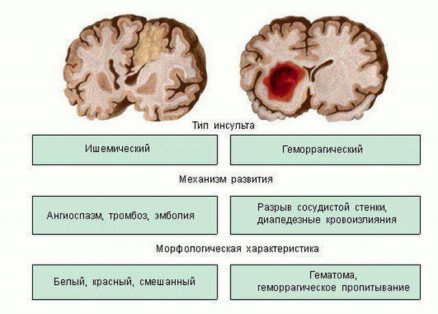 Инсульт мозжечка: лечение, прогноз, последствия, признаки Инсульт мозжечка: лечение, прогноз, последствия, признаки