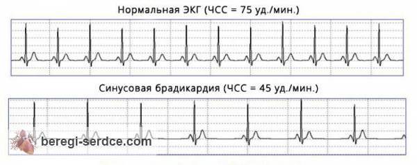ЭКГ признаки синусовой брадикардии ЭКГ признаки синусовой брадикардии