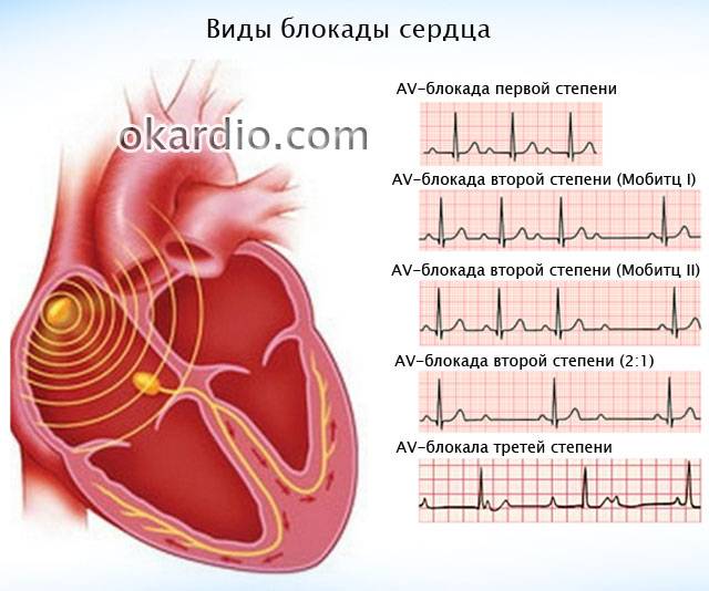 виды блокады сердца