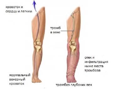 Причины и последовательность развития тромбоза глубоких вен нижних конечностей