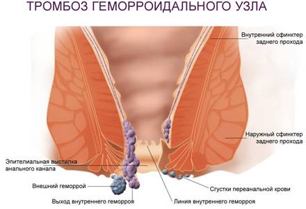 Схематическое изображение тромбоза геморроидального узла
