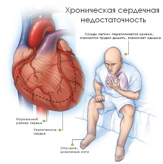 хроническая сердечная недостаточность хроническая сердечная недостаточность