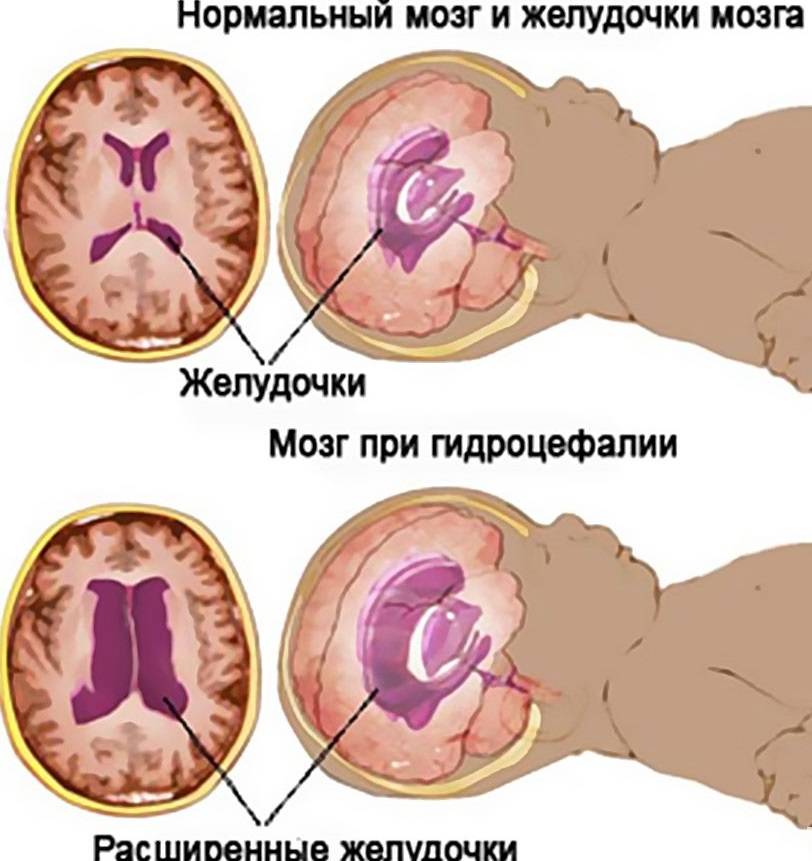Синдром внутричерепной гипертензии