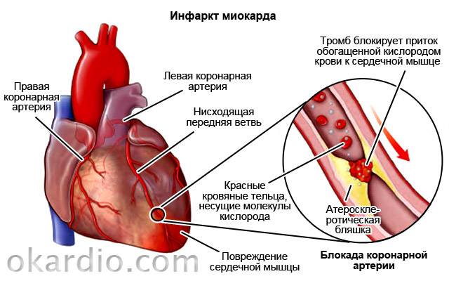 инфаркт миокарда
