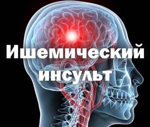 Последствия ишемического инсульта левой стороны
