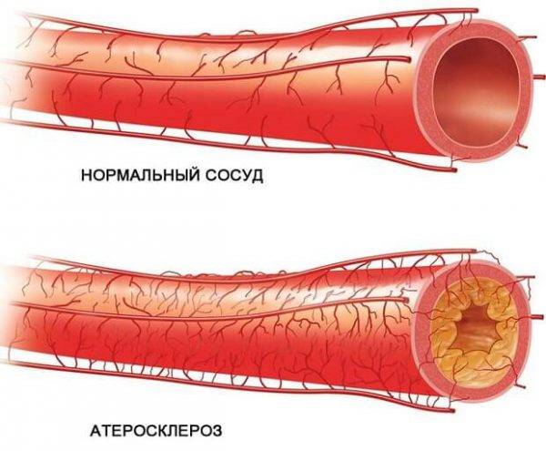 Коронарные артерии
