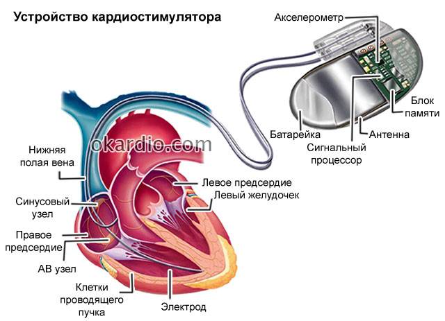 устройство кардиостимулятора