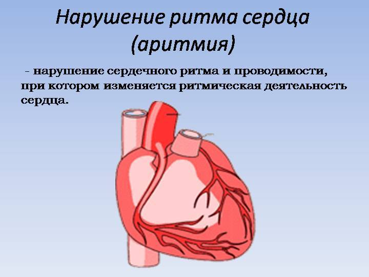 Аритмия сердца Аритмия сердца