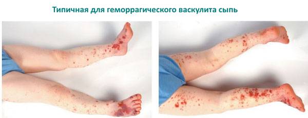 Высыпания при геморрагическом васкулите у детей