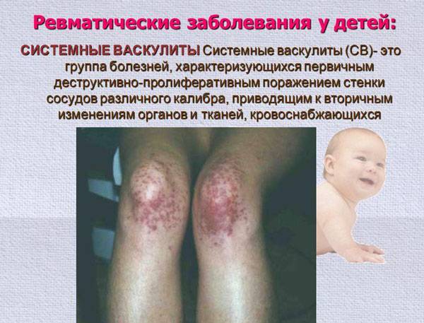 Ревматические заболевания у детей