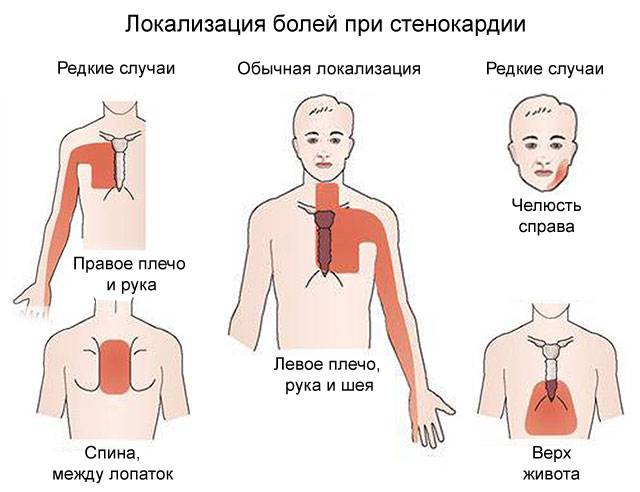 локализация болей при стенокардии