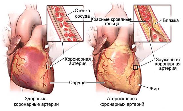 атеросклероз коронарных артерий