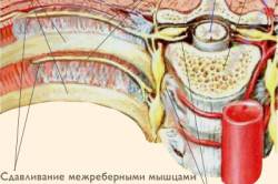 Межреберная невралгия