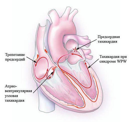 Питание при тахикардии