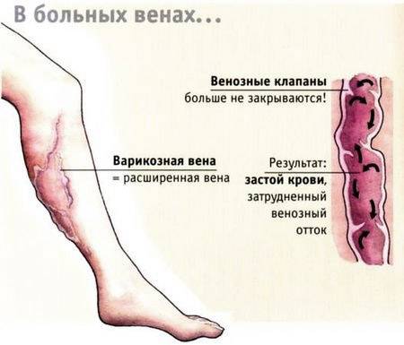 Что такое варикозное расширение вен