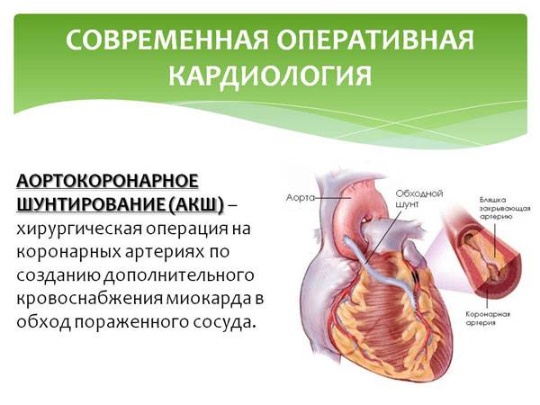 Аортокоронарное шунтирование