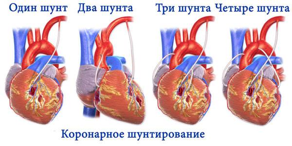 Коронарное шунтирование