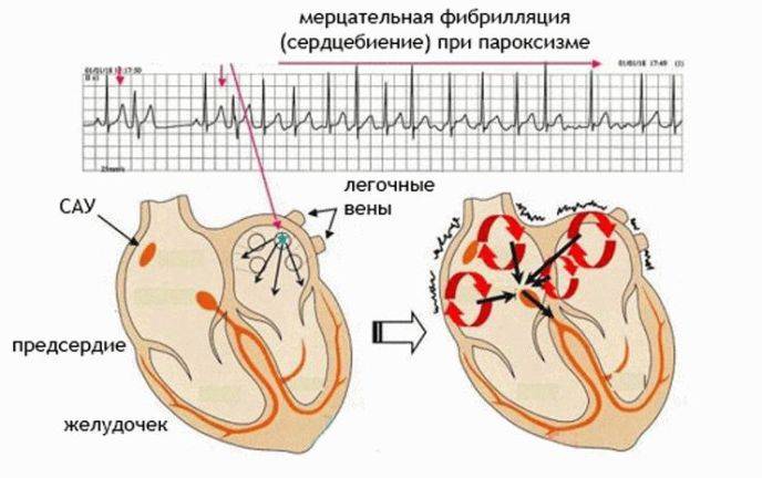 Пароксизмальная форма фибрилляции предсердий - особенности