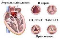 Пластика митрального клапана