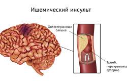 Схема ишемического инсульта