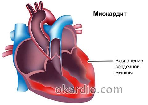 миокардит