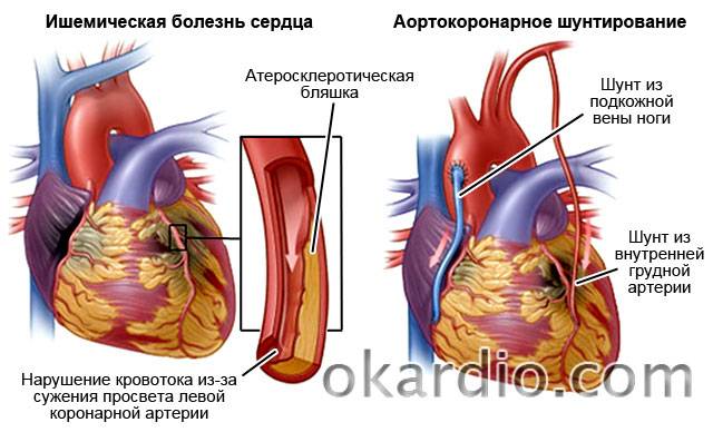 аортокоронарное шунтирование