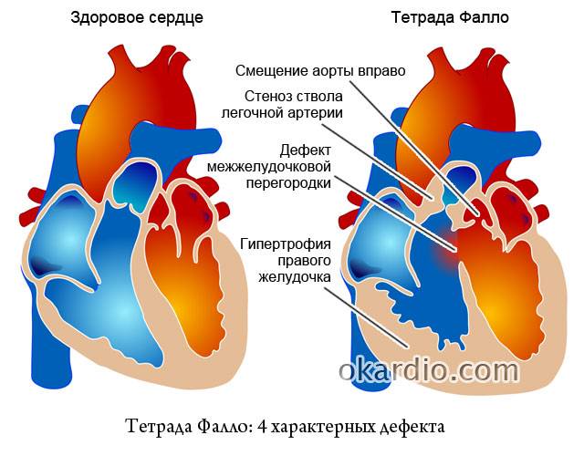 тетрада Фалло