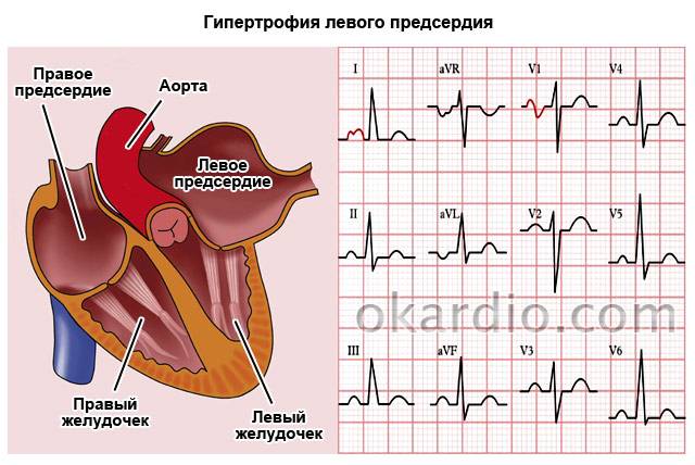гипертрофия левого предсердия