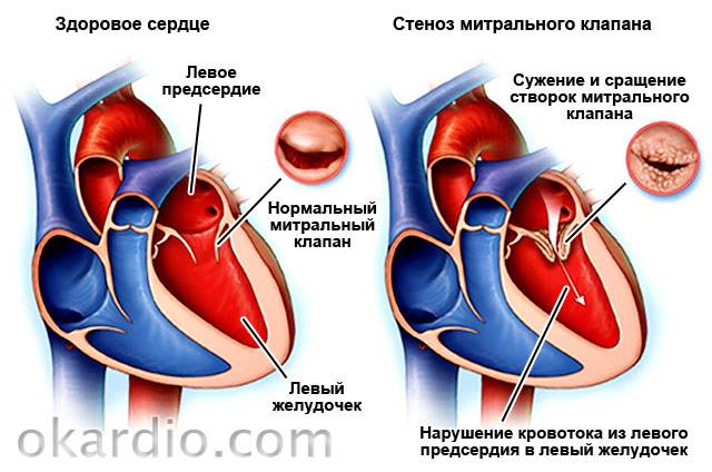 стеноз митрального клапана
