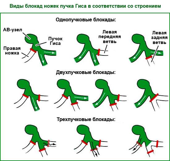 виды блокад ножек пучка Гиса