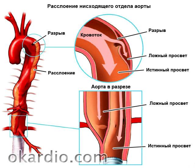 расслоение аорты