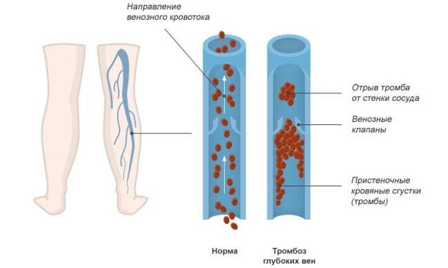 Развитие тромбоза глубоких вен нижних конечностей Развитие тромбоза глубоких вен нижних конечностей