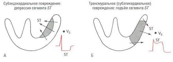 Субэндокардиальное и субэпикардиальное повреждение Отличие субэндокардиального и субэпикардиального повреждений