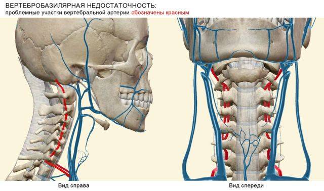 вертебро базилярная недостаточность