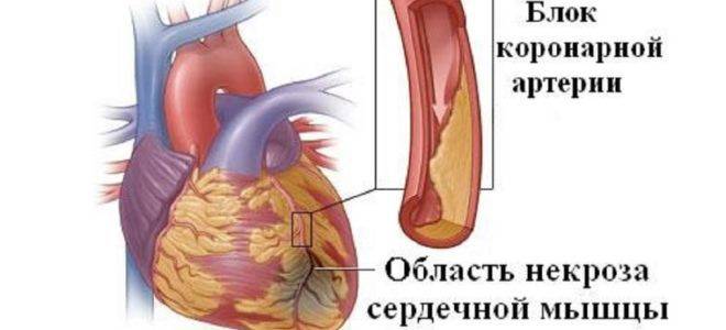причины инфаркта миокарда