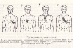 Варианты шумов сердца
