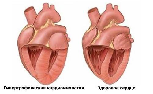 Гипертрофическая кардиомиопатия Гипертрофическая кардиомиопатия