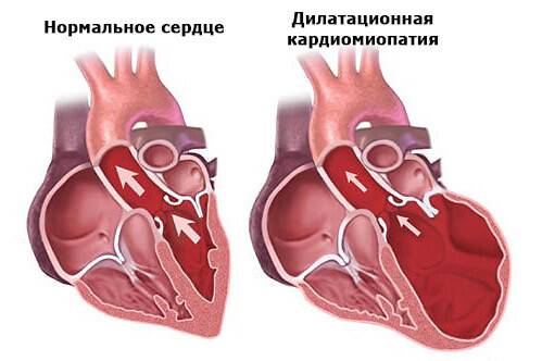 Дилатационная кардиомиопатия Дилатационная кардиомиопатия