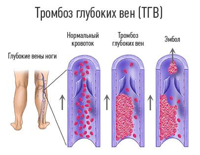 Тромбоз вен голени Тромбоз вен голени