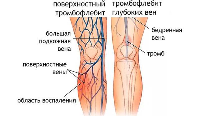 Виды тромбофлебита ног