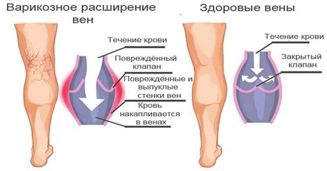 Варикозное расширение вен