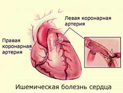 ишемическая болезнь сердца
