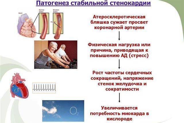 Стенокардия