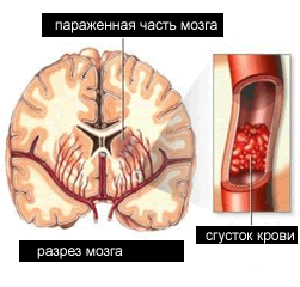 что такое сужение сосудов головного мозга