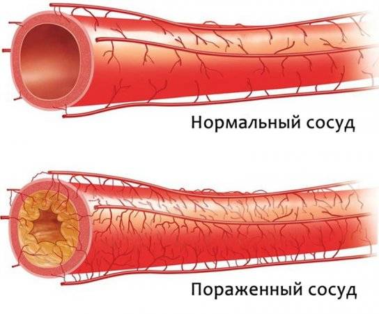 Операция по шунтированию сосудов