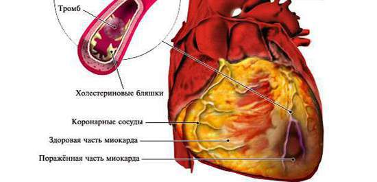 Можно ли курить после инфаркта