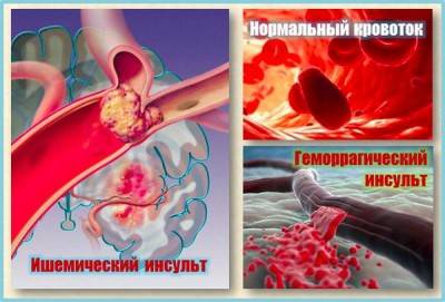 инсульт